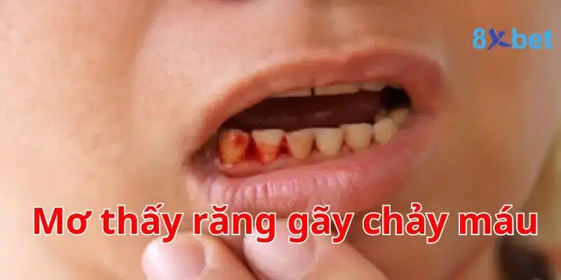 Giải mã giấc mơ, nằm mơ thấy máu nên đánh số nào? 3 Mơ thấy răng gãy chảy máu